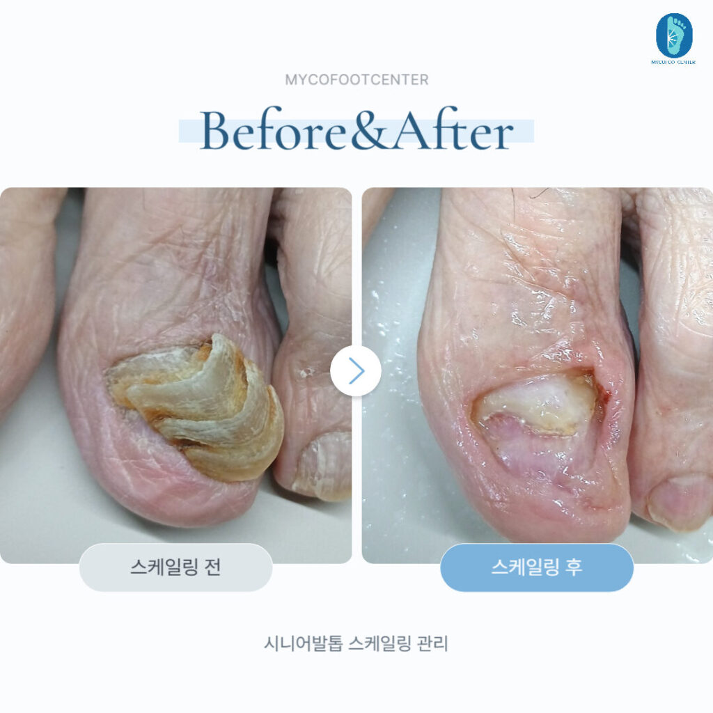 시니어발톱 스케일링 관리