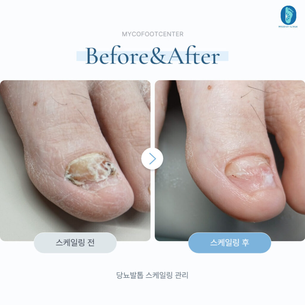 당뇨발톱 스케일링 관리