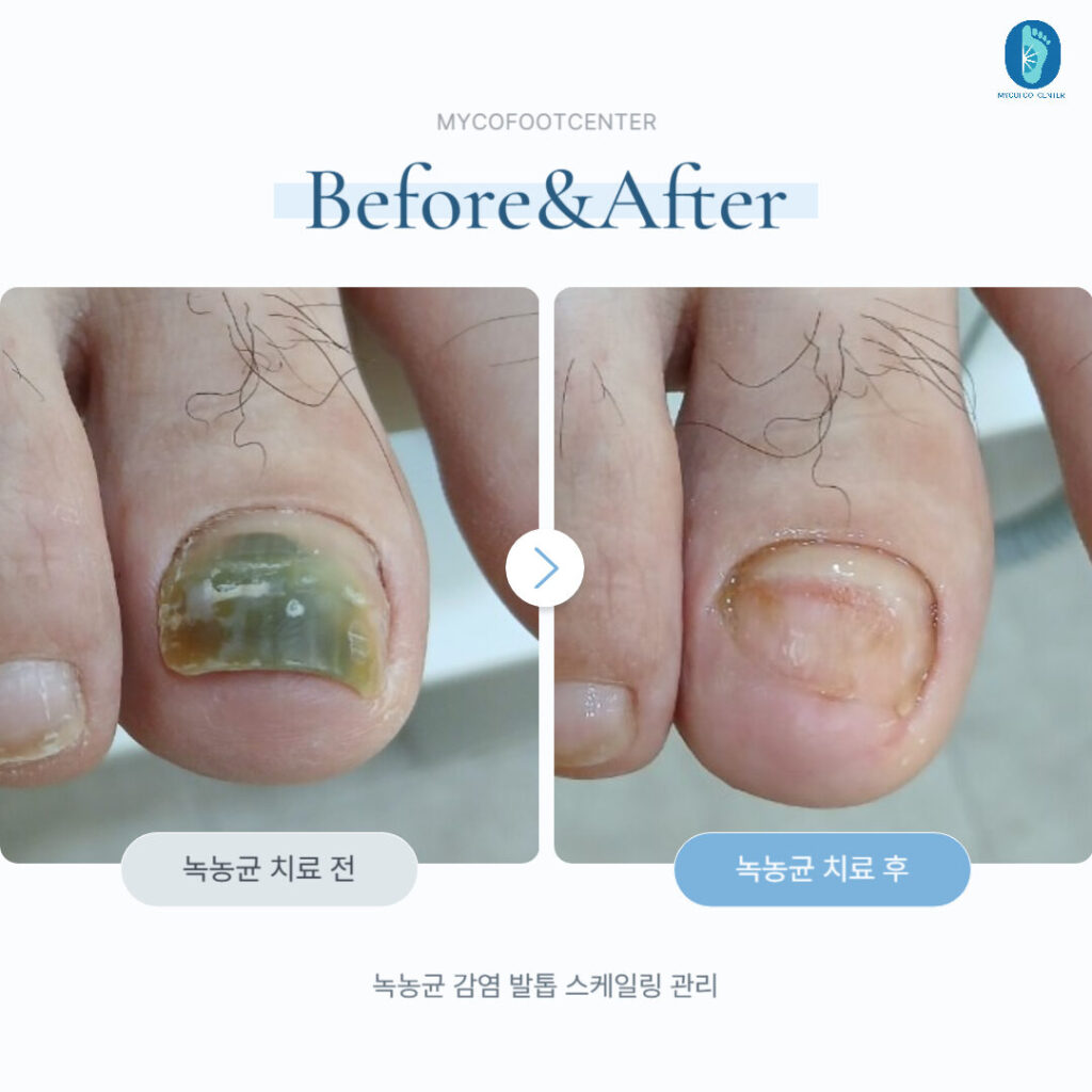 녹농균 감염 발톱 스케일링 관리